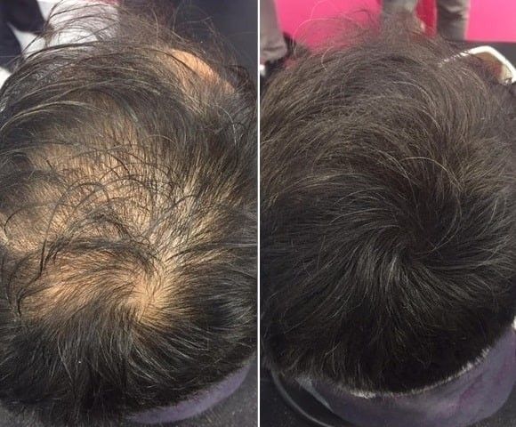 Comparación capilar 4