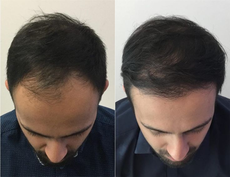 Comparación capilar 5
